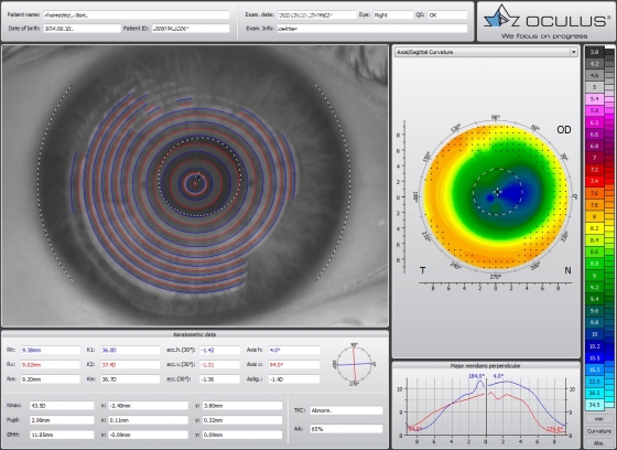 Топографическая карта роговицы после LASIK