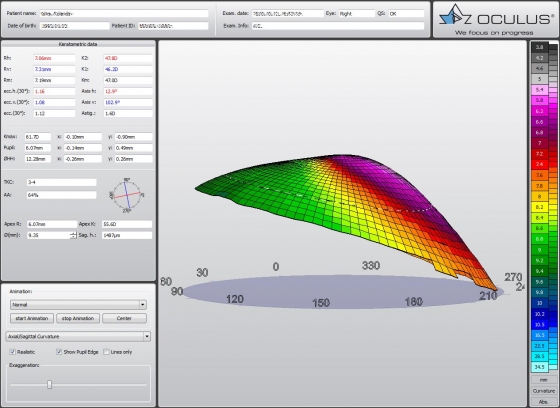 Вид топографии роговицы сбоку
