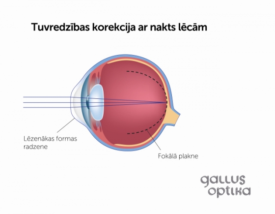 Tuvredzības korekcija ar nakts lēcām pēc lēcu noņemšanas