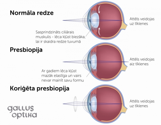 Presbiopijas koriģēšana