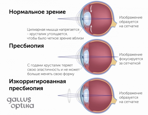 Коррекция пресбиопии