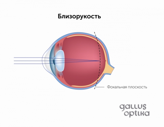 Близорукость без коррекции