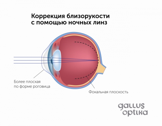 Эффект коррекции близорукости с помощью ночных линз