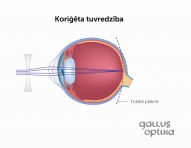 Tuvredzības korekcija ar briļļu lēcām