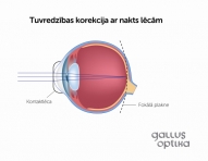 Tuvredzības korekcija ar nakts lēcām uz acīm