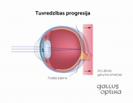 Acs ābola garuma pieaugums un tuvredzības progresija