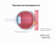 Вытягивание глазного яблока и прогрессия близорукости